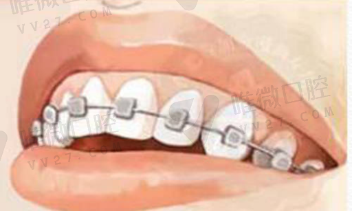 乳牙透明冠优缺点（乳牙透明冠修复步骤）(图1)